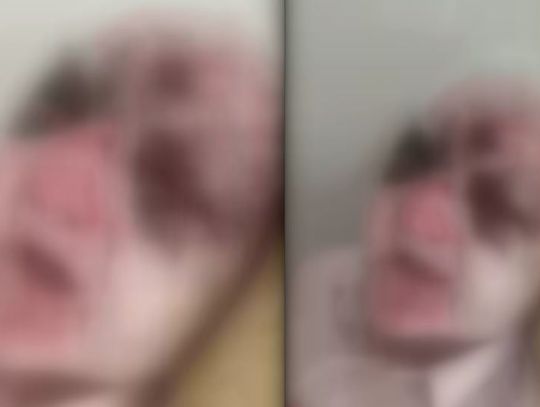 Ofiara czwartkowego potrącenia walczy o zdrowie. Policja prowadzi postępowanie [fot. zawarte w artykule nie są przeznaczone dla osób wrażliwych]